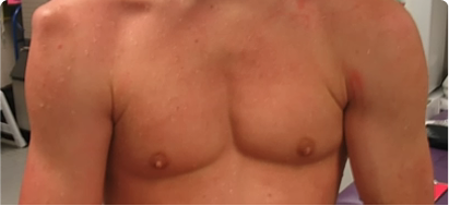 Inside view of joint during dislocation  and reduction